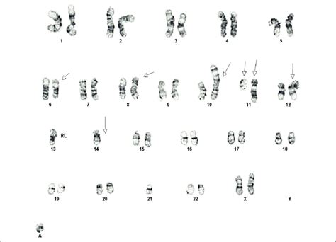 above chromosome analysis showing abnormal female complex karyotype download scientific