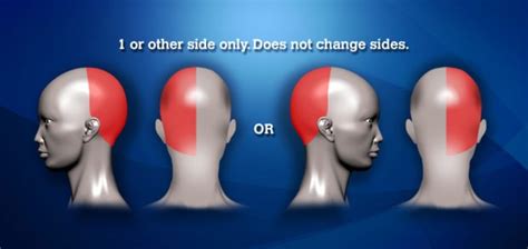 Types Of Headaches And Headache Location Chart Virtual Headache Specialist