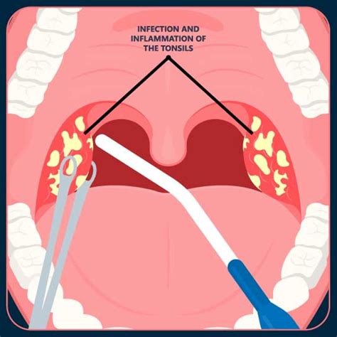 Best Tonsil Removal Tonsillectomy Surgery And Treatment In Mandya At