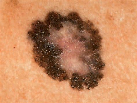 How Deadly Is Melanoma Skin Cancer Cancerwalls