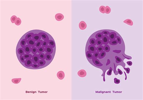 What Are The Differences Between Malignant And Benign Tumours
