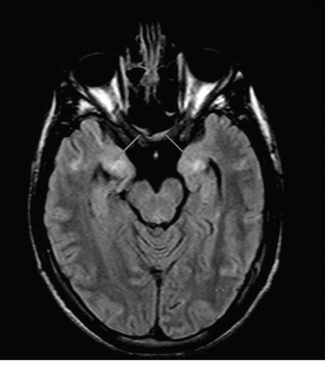 Mri Brain Showing Hyper Intensities In Bilateral Medial Temporal Lobes