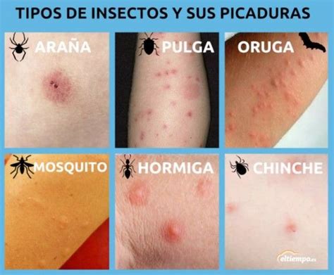 Picaduras Picaduras Picaduras De Araña Picaduras De Insectos