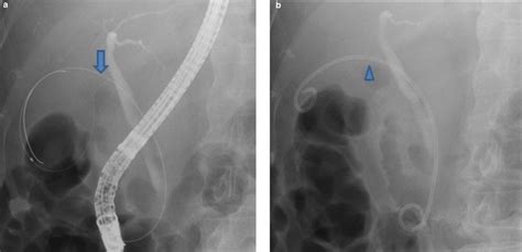 Endoscopic Retrograde Cholangiopancreatography Ercp Catheter Was