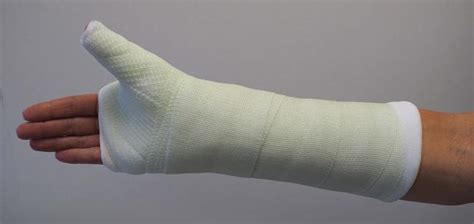 What Type Of Splint Is Used For A Distal Radius Fracture