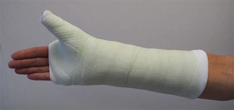 Scaphoid Fracture of the Wrist - OrthoInfo - AAOS
