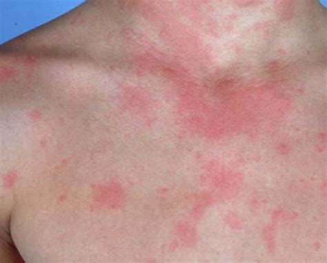 Urticaria Hives In Children Symptoms Rash Causes Trea