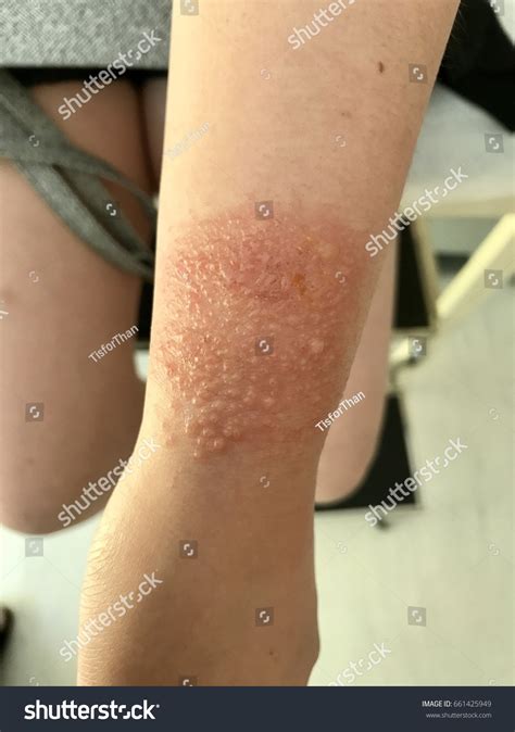 Eczema On Wrist