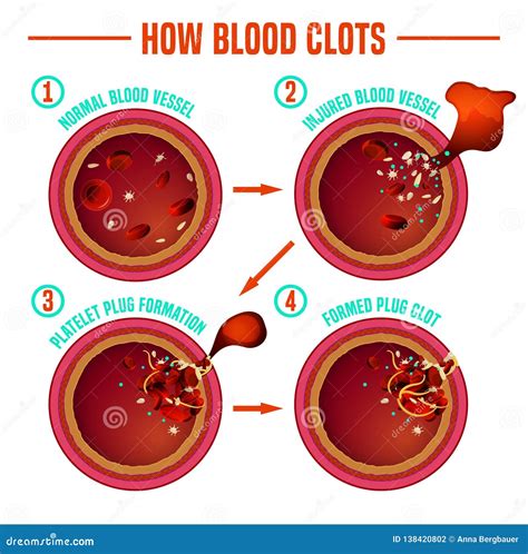 Blood Clotting 5 Stage Infographics Vector Illustration