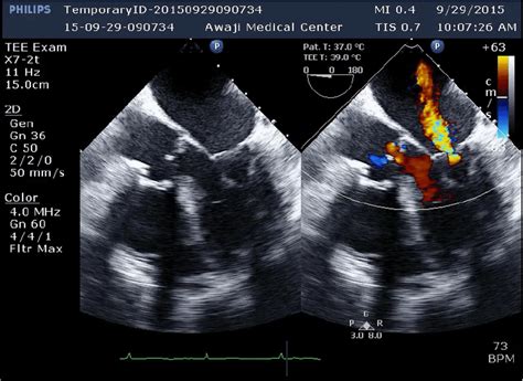 Mitral Valve Prolapse Echocardiography