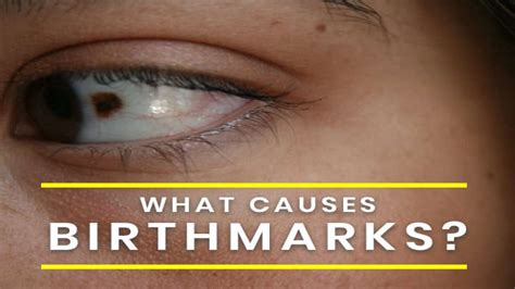 Do You Have A Birthmark Its Causes Types Complications And Treatment