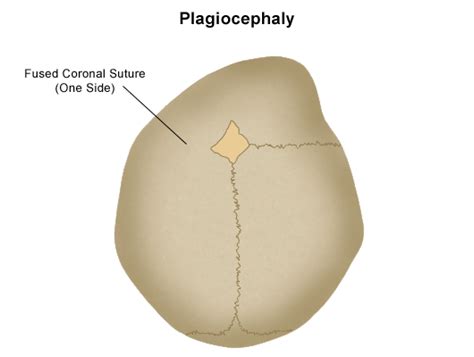 Plagiocephaly Stanford Health Care