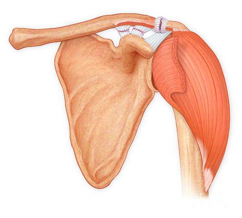 Torn Shoulder Ligaments Photograph By Medical Imagery Studiosdesign