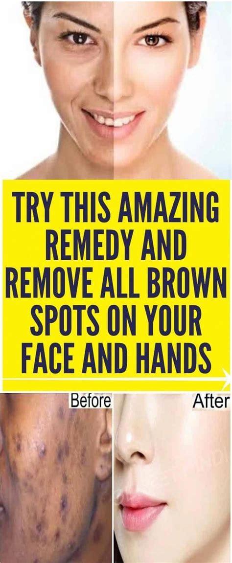 Ways To Get Rid Of Brown Spots On Face Darkbrownspotsonface