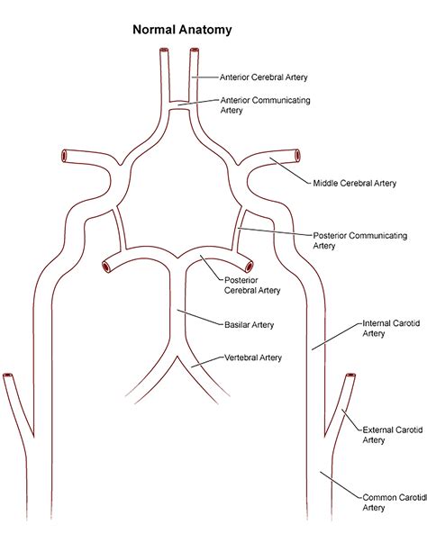 Unilateral Agenesis Of The Internal Carotid Artery With Intracavernous Carotid Carotid