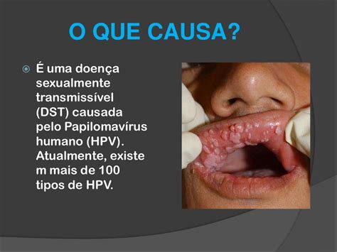 Periodo De Incubação Hpv