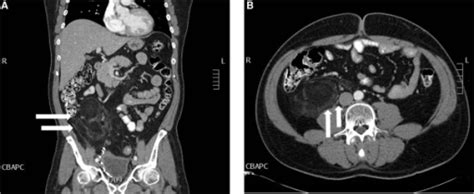 A Abdominal Ct With Contrast Reveals A Fat Density Ma Open I