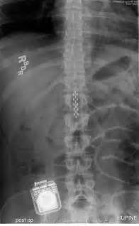 Spinal cord stimulator