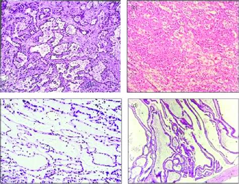 Uncommon Histologic Types Of Renal Cell Carcinoma Rcc Collecting