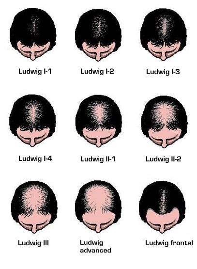 From alopecia sufferer to certified trichologist. Haarausfall: Formen & Ursachen | FUE-Haartransplantation