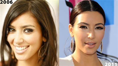 kourtney kardashian plastic surgery before and after photos