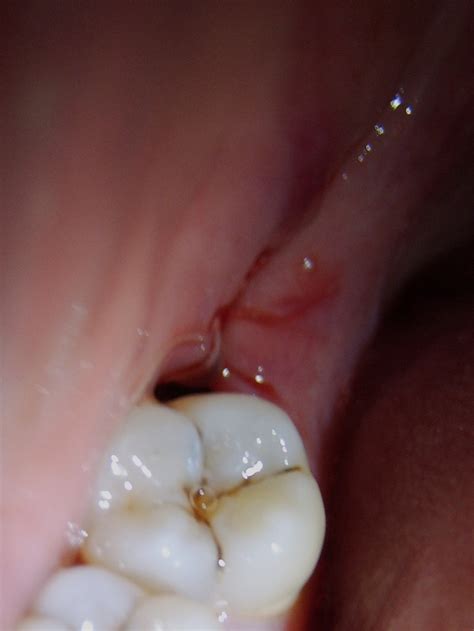 My Tooth Extracted Had My Lower Right Wisdom Tooth Extra Flickr