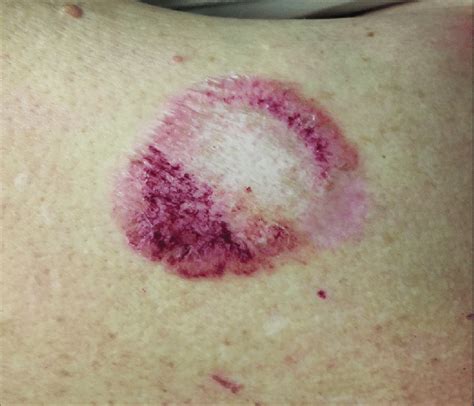 Hemorrhagic Bullous Ls After 8 Weeks Of Treatment With Topical