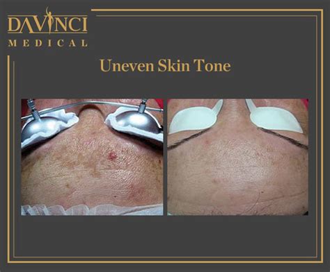 Da Vinci Clinic Skin Brightening Toning Rejuvenation Treatment