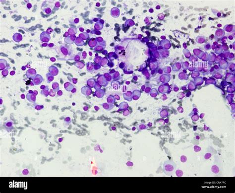 Cancer Cells Stock Photo Alamy