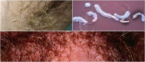 Trichomycosis Causes Symptoms Diagnosis And Treatment Hoool