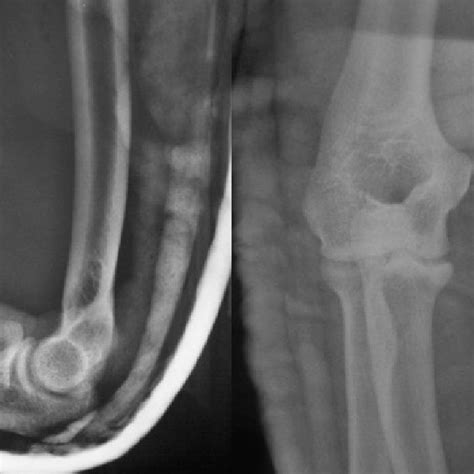 Anterior Posterior And Lateral Radiographs Of The Elbow In A Patient