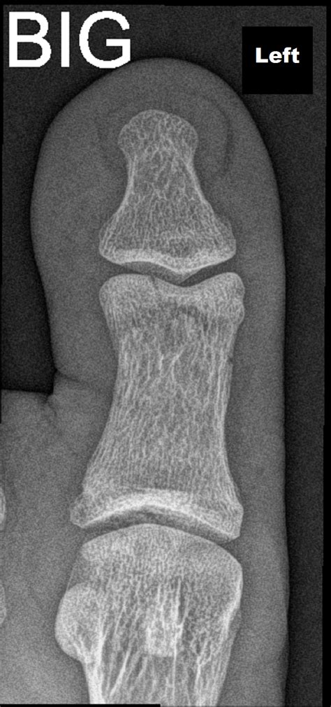 Fracture Head Of The Proximal Phalanx Of The Big Toe Image