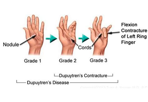 Dupuytrens Contracture And How To Know If You Have It Healthwise