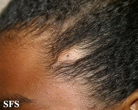 Alopecia physical examination - wikidoc