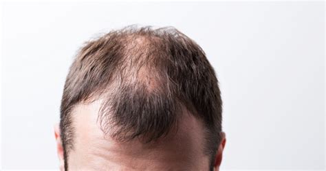 30 Haircuts For Balding Crown To Fix Bald Spots Fast