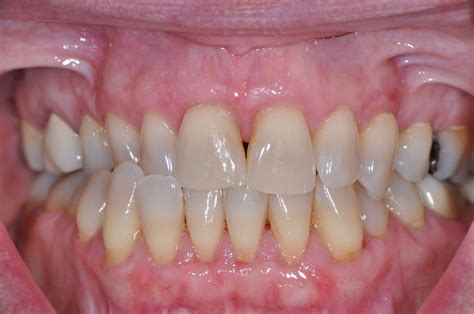 Gingival Gum Grafting Dental Implants And Periodontics Of Ct