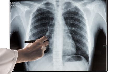 Only your doctor can give you a correct diagnosis. Costochondritis: Causes, symptoms, and treatment - Med ...