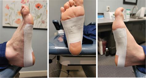 Functional Anatomic Support Taping Fast A Novel Method For Plantar