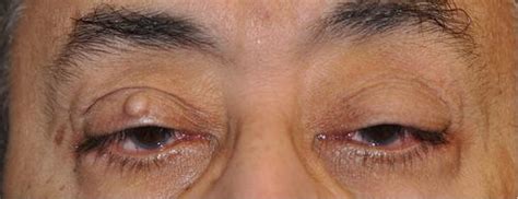 Epithelial Inclusion Cysts | SpringerLink