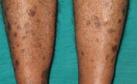 Liver Spots On Legs And Arms
