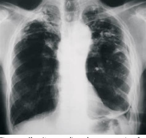 Figure 2 From Pleural Effusion Caused By Nontuberculous Mycobacteria