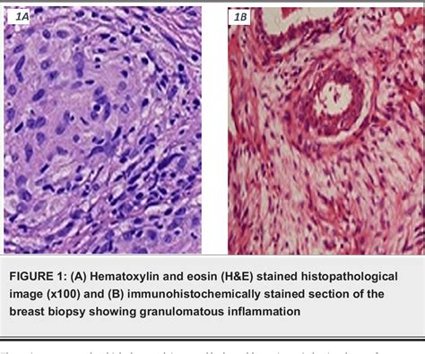 Figure 1 From A Rare Case Of Granulomatous Mastitis Associated With