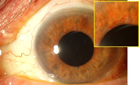 Glaucoma is defined as a group of diseases that cause a characteristic change in the optic nerve with associated loss of visual field/function. Glaucoma Information Secondary glaucoma - Can diabetes ...