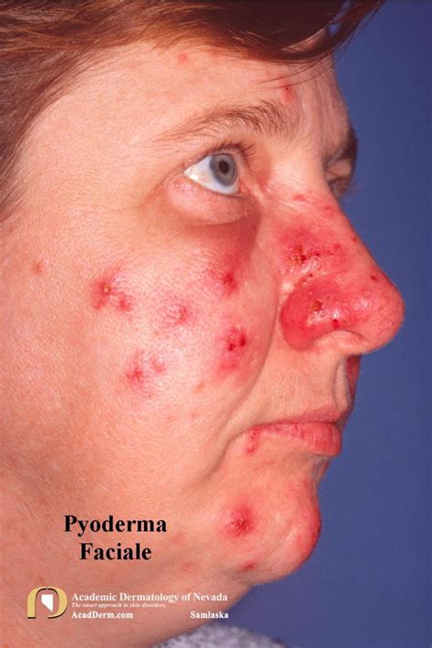 Complex Acne Disorders Pyoderma Faciale Academic Dermatology Of