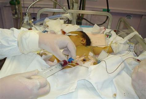 The patient's blood is removed and replaced by donated blood or blood components. Case Quiz: A Newborn With Strange Coloration