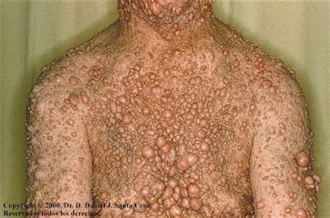 Consult a doctor for medical advice. EL FIN DEL MUNDO: Neurofibromatosis, una enfermedad terrible