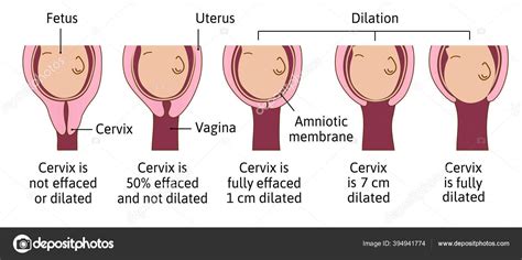 cervix dilation chart labor