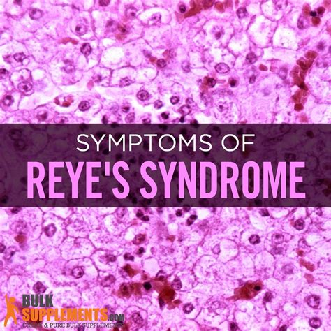 Reyes Syndrome Causes Symptoms And Treatment By James Denlinger Medium