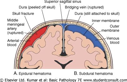 An epidural hematoma is caused by a blow to the side of the head, in the temple area. HEMATOMA EPIDURAL SUBDURAL Y PARENQUIMATOSO - Wroc?awski ...