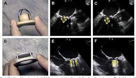 Figure From Mitral Prosthetic Valve Assessment By Echocardiographic